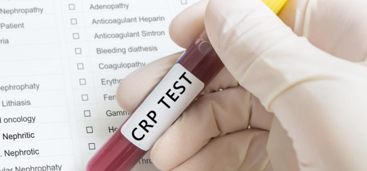 Các chỉ số trong kết quả xét nghiệm CRP nói lên điều gì?