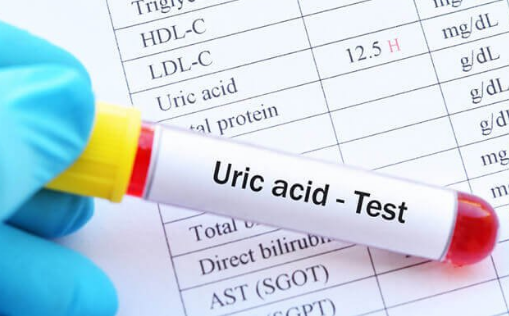 Ý nghĩa việc xét nghiệm acid uric máu và giải pháp khi acid uric tăng